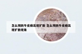 怎么預(yù)防牛皮癬出現(xiàn)擴(kuò)散 怎么預(yù)防牛皮癬出現(xiàn)擴(kuò)散現(xiàn)象