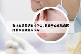 吉林治銀屑病安排華山l 長春華山皮膚病醫(yī)院治銀屑病能去根嗎