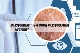 腳上牛皮癬用什么可以緩解 腳上牛皮膚癬用什么藥膏最好