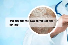 皮膚變硬變厚是什么癬 皮膚變硬變厚是什么癬引起的