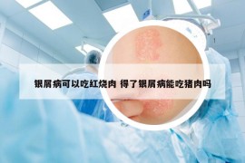 銀屑病可以吃紅燒肉 得了銀屑病能吃豬肉嗎