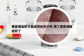 銀屑病治好了會遺傳給孩子嗎 得了銀屑病最后好了