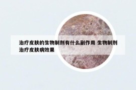 治療皮膚的生物制劑有什么副作用 生物制劑治療皮膚病效果