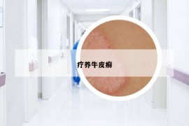 療養(yǎng)牛皮癬