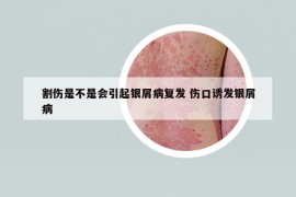 割傷是不是會引起銀屑病復(fù)發(fā) 傷口誘發(fā)銀屑病