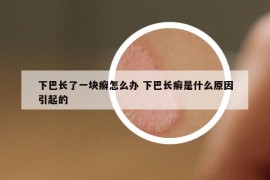 下巴長了一塊癬怎么辦 下巴長癬是什么原因引起的