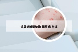 銀屑病辨證論治 銀屑病 辯證