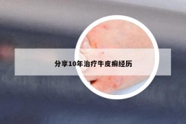 分享10年治療牛皮癬經(jīng)歷