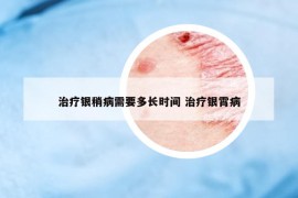 治療銀稍病需要多長(zhǎng)時(shí)間 治療銀霄病