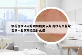 銀花虎杖湯治療銀屑病關(guān)節(jié)炎 虎杖與白花蛇舌草一起飲用能治什么病