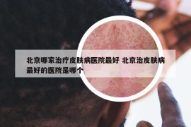北京哪家治療皮膚病醫(yī)院最好 北京治皮膚病最好的醫(yī)院是哪個(gè)