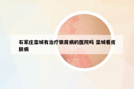 石家莊欒城有治療銀屑病的醫(yī)院嗎 欒城看皮膚病