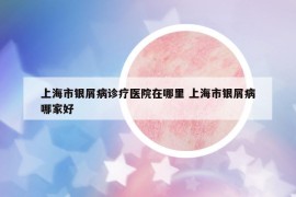 上海市銀屑病診療醫(yī)院在哪里 上海市銀屑病哪家好