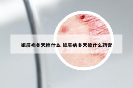 銀屑病冬天擦什么 銀屑病冬天擦什么藥膏
