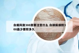 白癜風(fēng)做308需要注意什么 白顛瘋病照308最少要照多久