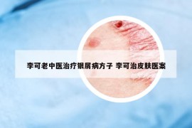 李可老中醫(yī)治療銀屑病方子 李可治皮膚醫(yī)案