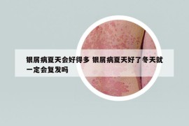 銀屑病夏天會好得多 銀屑病夏天好了冬天就一定會復(fù)發(fā)嗎