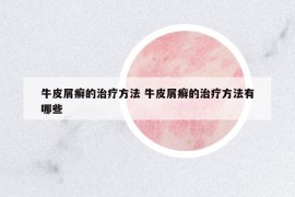 牛皮屑癬的治療方法 牛皮屑癬的治療方法有哪些
