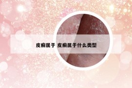 皮癬屬于 皮癬屬于什么類型