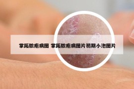 掌跖膿皰病圖 掌跖膿皰病圖片初期小泡圖片