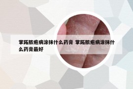 掌跖膿皰病涂抹什么藥膏 掌跖膿皰病涂抹什么藥膏最好