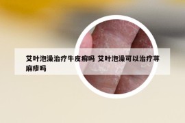 艾葉泡澡治療牛皮癬嗎 艾葉泡澡可以治療蕁麻疹嗎