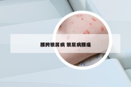 腰胯銀屑病 銀屑病腰痛