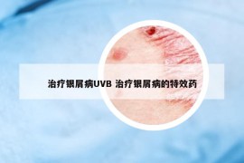 治療銀屑病UVB 治療銀屑病的特效藥
