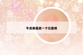 牛皮癬是就一個(gè)位置癢