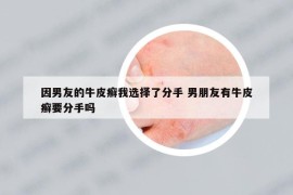 因男友的牛皮癬我選擇了分手 男朋友有牛皮癬要分手嗎