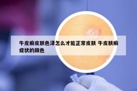 牛皮癬皮膚色澤怎么才能正常皮膚 牛皮膚癬癥狀的顏色
