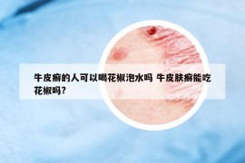 牛皮癬的人可以喝花椒泡水嗎 牛皮膚癬能吃花椒嗎?