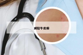 減輕牛皮癬
