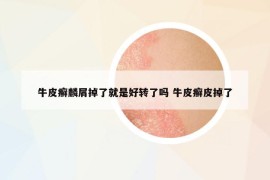 牛皮癬麟屑掉了就是好轉了嗎 牛皮癬皮掉了