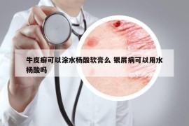 牛皮癬可以涂水楊酸軟膏么 銀屑病可以用水楊酸嗎