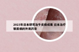 2023年日本研究治牛皮癬成果 日本治療銀屑病的外用藥膏