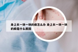 身上長(zhǎng)一塊一塊的癬怎么辦 身上長(zhǎng)一塊一塊的癬是什么原因