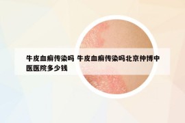 牛皮血癬傳染嗎 牛皮血癬傳染嗎北京仲博中醫(yī)醫(yī)院多少錢(qián)