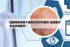 福建銀屑病哪個(gè)醫(yī)院比較好的醫(yī)院 福建最好的皮膚病醫(yī)院