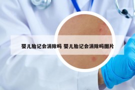 嬰兒胎記會(huì)消除嗎 嬰兒胎記會(huì)消除嗎圖片