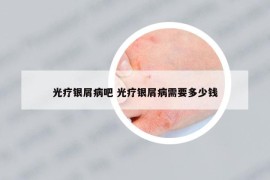 光療銀屑病吧 光療銀屑病需要多少錢