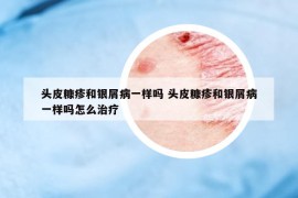 頭皮糠疹和銀屑病一樣嗎 頭皮糠疹和銀屑病一樣嗎怎么治療