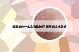銀屑病吃什么食物比較好 銀屑病吃啥最好