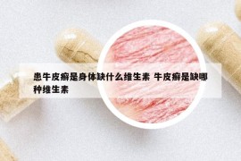 患牛皮癬是身體缺什么維生素 牛皮癬是缺哪種維生素