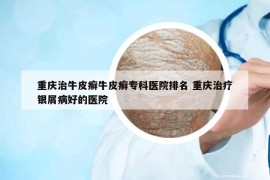 重慶治牛皮癬牛皮癬?？漆t(yī)院排名 重慶治療銀屑病好的醫(yī)院