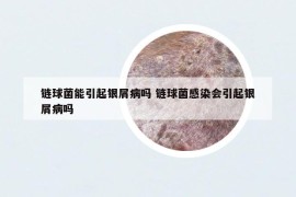 鏈球菌能引起銀屑病嗎 鏈球菌感染會(huì)引起銀屑病嗎