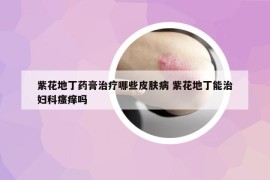 紫花地丁藥膏治療哪些皮膚病 紫花地丁能治婦科瘙癢嗎