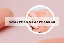 皮膚破了之后長癬 皮膚破了之后長癬怎么辦