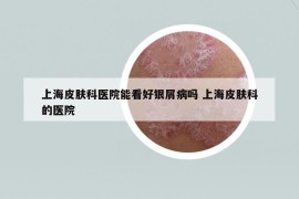 上海皮膚科醫(yī)院能看好銀屑病嗎 上海皮膚科的醫(yī)院