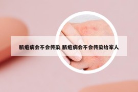 膿皰病會(huì)不會(huì)傳染 膿皰病會(huì)不會(huì)傳染給家人
